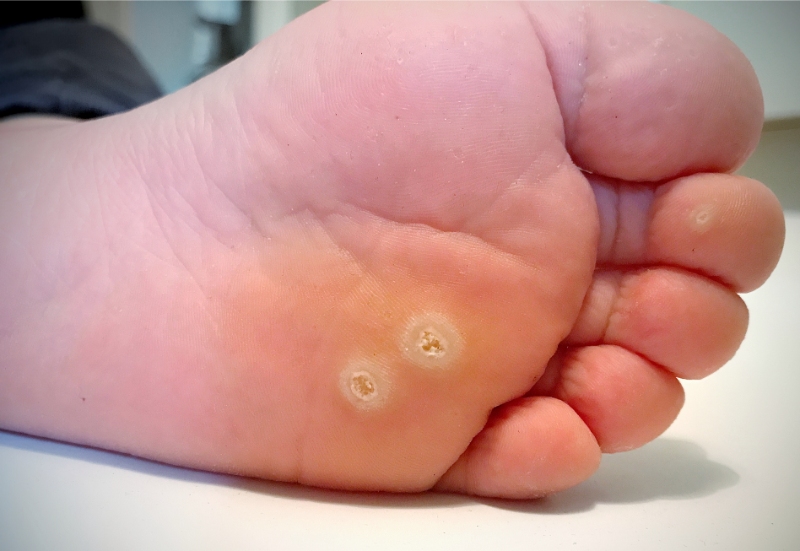 Warts